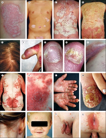 Skin disorder